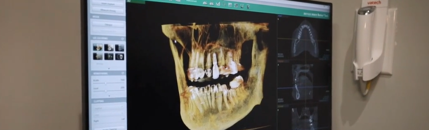 Root canal X-ray imaging at Millpond Family Dental in Cary NC