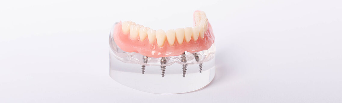Dental implants Cary NC